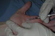 نتیجه تصویری برای تزریق بوتاکس در دست